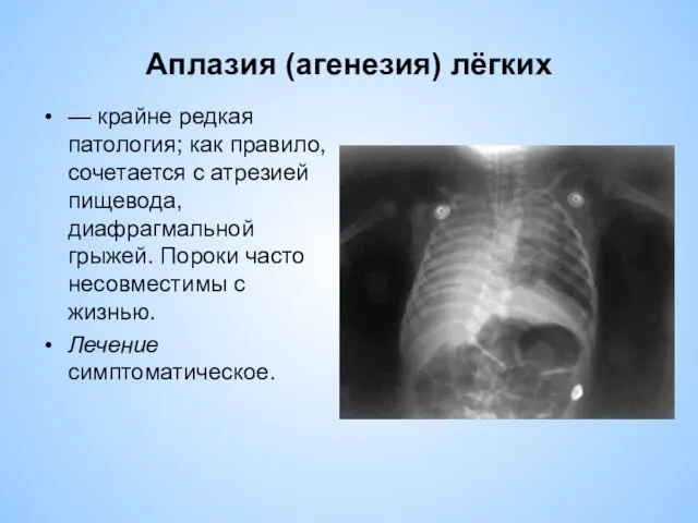 Аплазия (агенезия) лёгких — крайне редкая патология; как правило, сочетается с