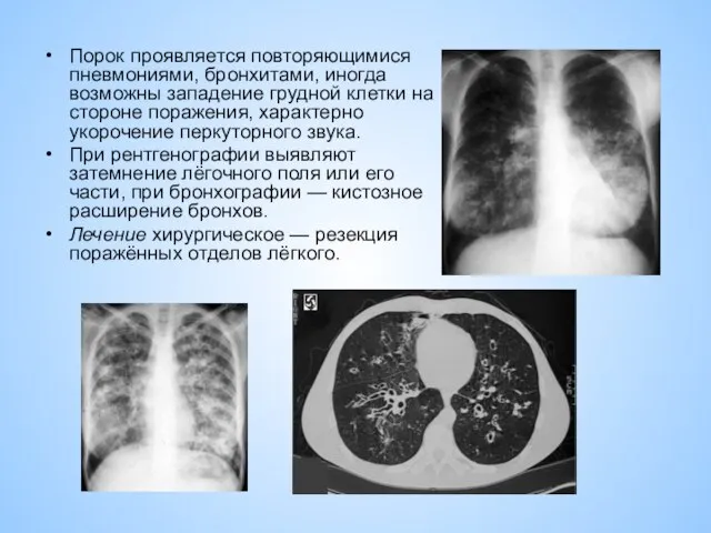 Порок проявляется повторяющимися пневмониями, бронхитами, иногда возможны западение грудной клетки на