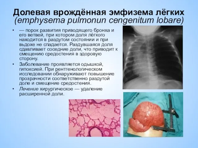 Долевая врождённая эмфизема лёгких (emphysema pulmonun cengenitum lobare) — порок развития