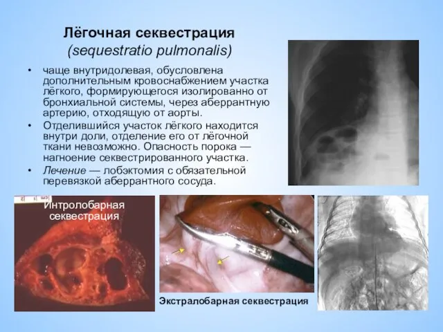 Лёгочная секвестрация (sequestratio pulmonalis) чаще внутридолевая, обусловлена дополнительным кровоснабжением участка лёгкого,