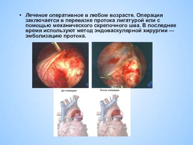 Лечение оперативное в любом возрасте. Операция заключается в перевязке протока лигатурой