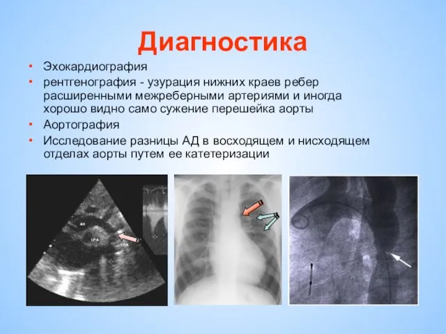 Диагностика Эхокардиография рентгенография - узурация нижних краев ребер расширенными межреберными артериями