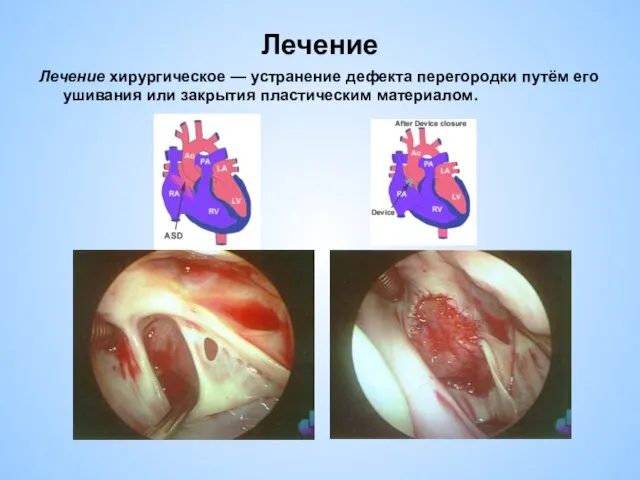 Лечение Лечение хирургическое — устранение дефекта перегородки путём его ушивания или закрытия пластическим материалом.