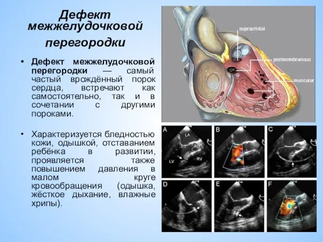 Дефект межжелудочковой перегородки Дефект межжелудочковой перегородки — самый частый врождённый порок