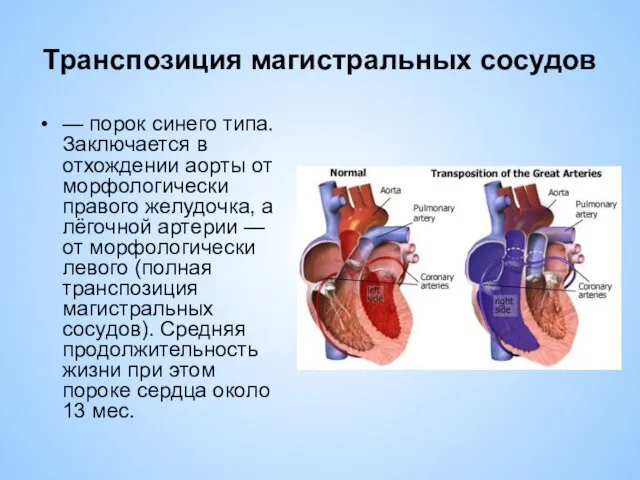 Транспозиция магистральных сосудов — порок синего типа. Заключается в отхождении аорты