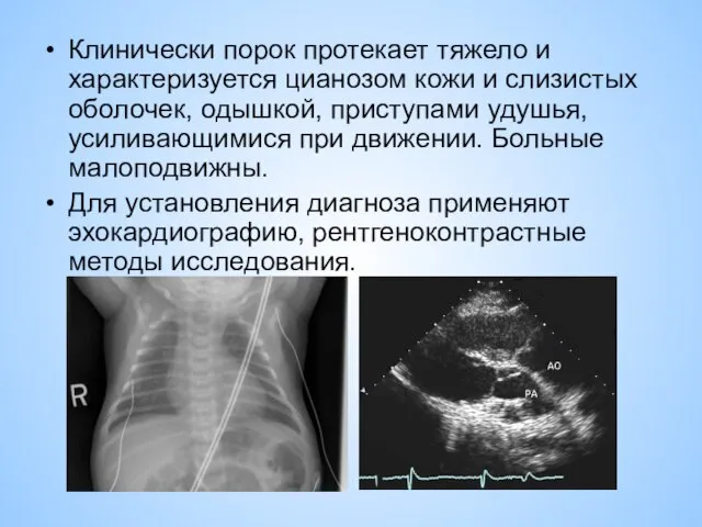 Клинически порок протекает тяжело и характеризуется цианозом кожи и слизистых оболочек,