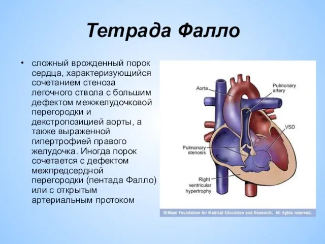 Тетрада Фалло сложный врожденный порок сердца, характеризующийся сочетанием стеноза легочного ствола