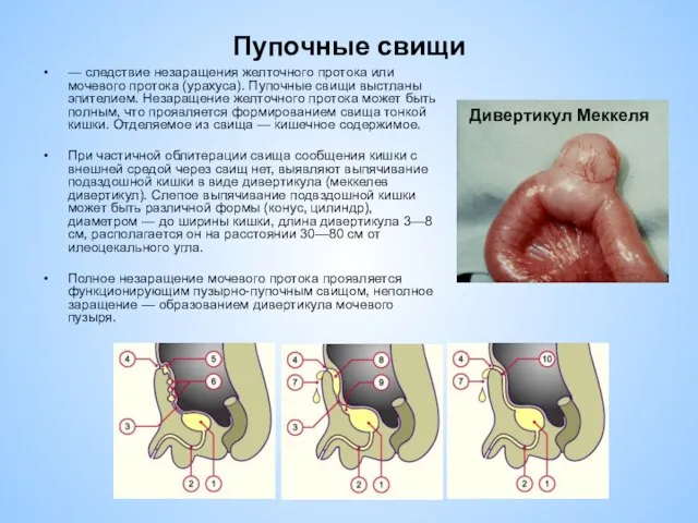 Пупочные свищи — следствие незаращения желточного протока или мочевого протока (урахуса).