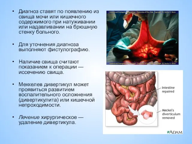 Диагноз ставят по появлению из свища мочи или кишечного содержимого при