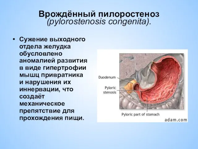 Врождённый пилоростеноз (pylorostenosis congenita). Сужение выходного отдела желудка обусловлено аномалией развития