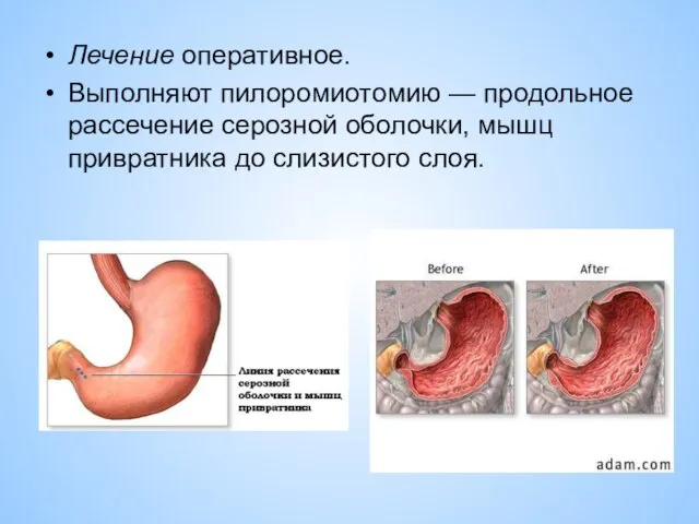 Лечение оперативное. Выполняют пилоромиотомию — продольное рассечение серозной оболочки, мышц привратника до слизистого слоя.