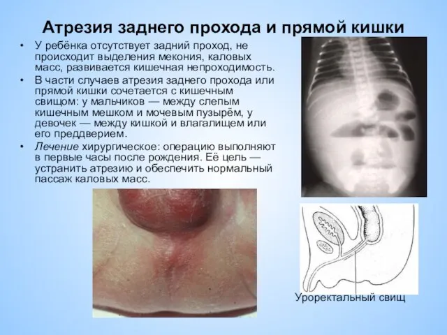 Атрезия заднего прохода и прямой кишки У ребёнка отсутствует задний проход,