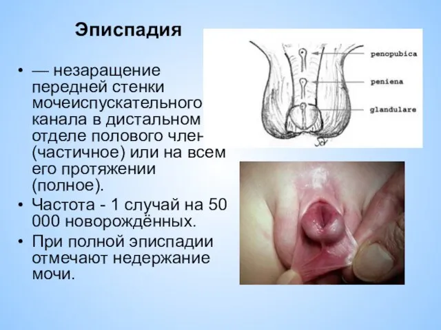 Эписпадия — незаращение передней стенки мочеиспускательного канала в дистальном отделе полового