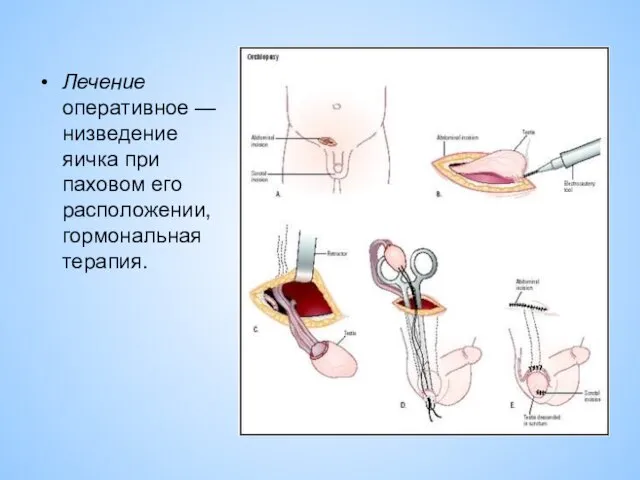 Лечение оперативное — низведение яичка при паховом его расположении, гормональная терапия.