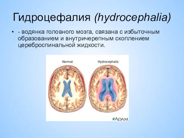 Гидроцефалия (hydrocephalia) - водянка головного мозга, связана с избыточным образованием и внутричерепным скоплением цереброспинальной жидкости.