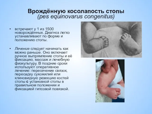 Врождённую косолапость стопы (pes equinovarus congenitus) встречают у 1 из 1500