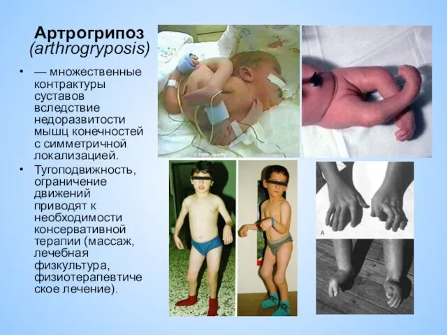 Артрогрипоз (arthrogryposis) — множественные контрактуры суставов вследствие недоразвитости мышц конечностей с