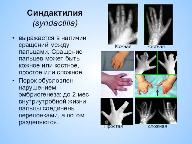 Синдактилия (syndactilia) выражается в наличии сращений между пальцами. Сращение пальцев может