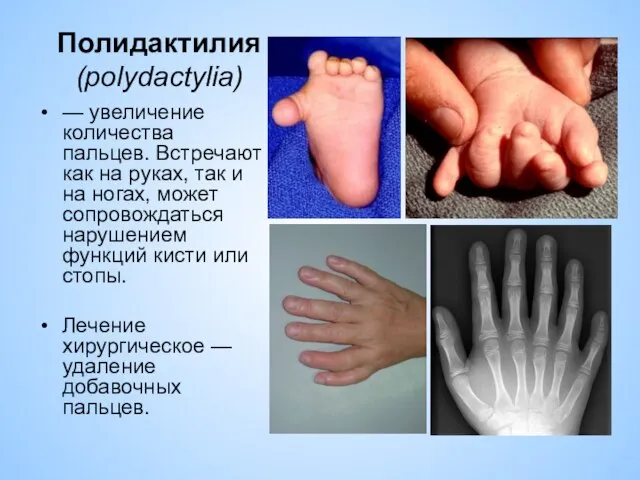 Полидактилия (polydactylia) — увеличение количества пальцев. Встречают как на руках, так