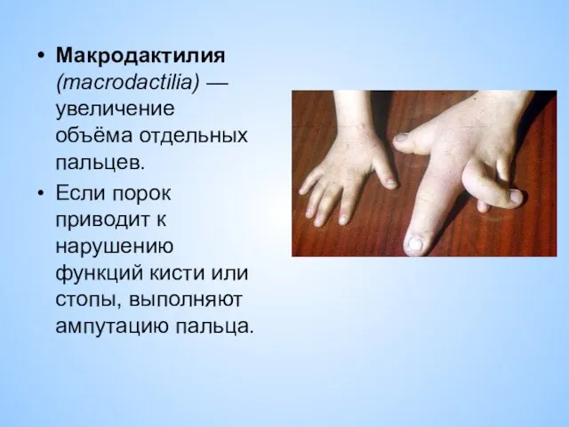 Макродактилия (macrodactilia) — увеличение объёма отдельных пальцев. Если порок приводит к