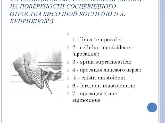 ТРЕПАНИЦИОННЫЙ ТРЕУГОЛЬНИК (ШИПО) НА ПОВЕРХНОСТИ СОСЦЕВИДНОГО ОТРОСТКА ВИСОЧНОЙ КОСТИ (ПО П.А.КУПРИЯНОВУ).