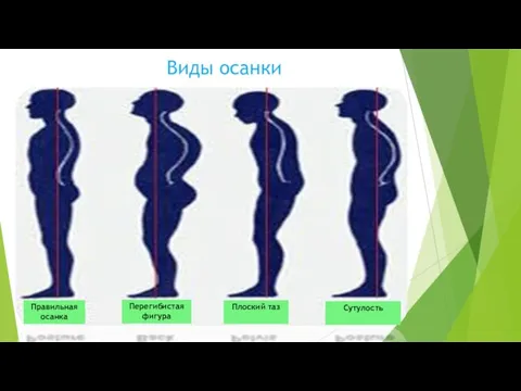 Виды осанки Правильная осанка Плоский таз Сутулость Перегибистая фигура