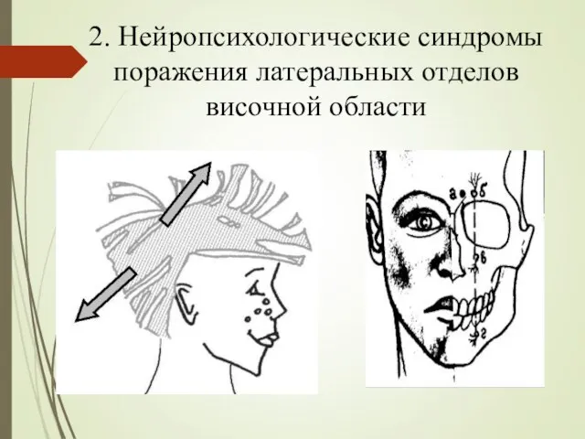 2. Нейропсихологические синдромы поражения латеральных отделов височной области