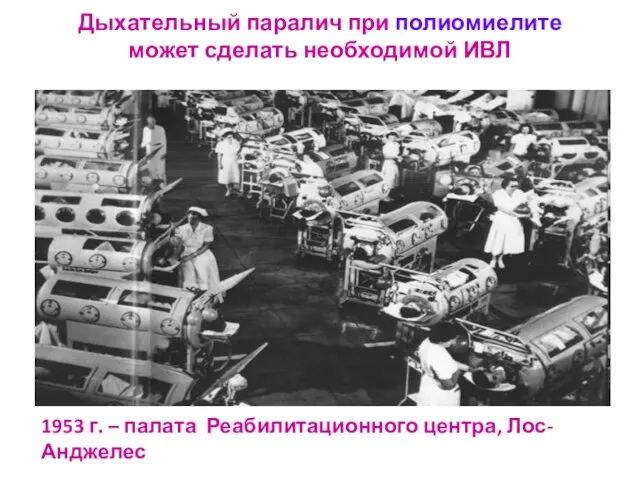 Дыхательный паралич при полиомиелите может сделать необходимой ИВЛ 1953 г. – палата Реабилитационного центра, Лос-Анджелес