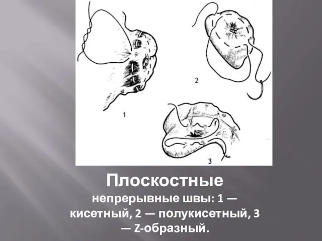 Плоскостные непрерывные швы: 1 —кисетный, 2 — полукисетный, 3 — Z-образный.