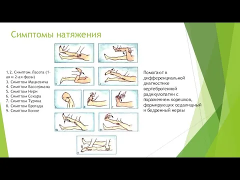 Симптомы натяжения Помогают в дифференциальной диагностике вертеброгенной радикулопатии с поражением корешков,