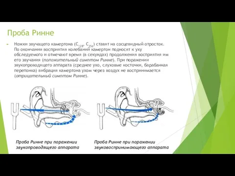 Проба Ринне Проба Ринне при поражении звукопроводящего аппарата Проба Ринне при