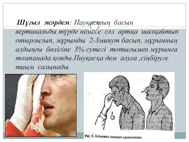 Шұғыл жәрдем: Науқастың басын вертикальды түрде немесе сәл артқа шалқайтып отырғызып,