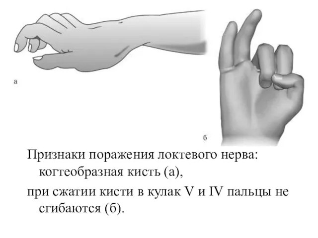 Признаки поражения локтевого нерва: когтеобразная кисть (а), при сжатии кисти в