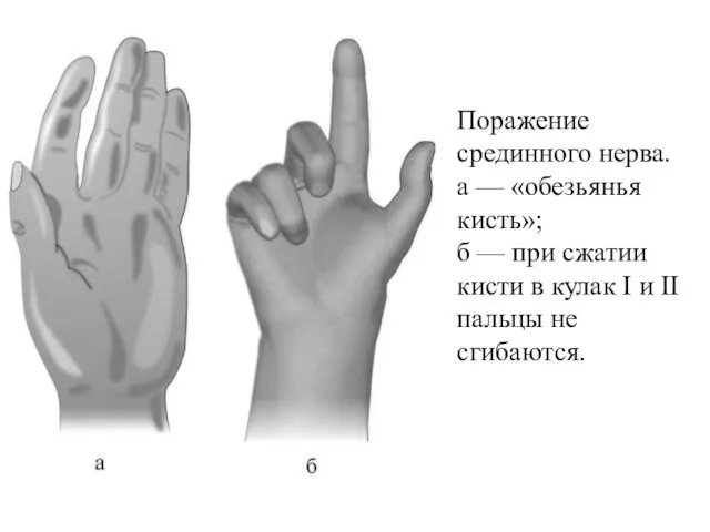 Поражение срединного нерва. а — «обезьянья кисть»; б — при сжатии