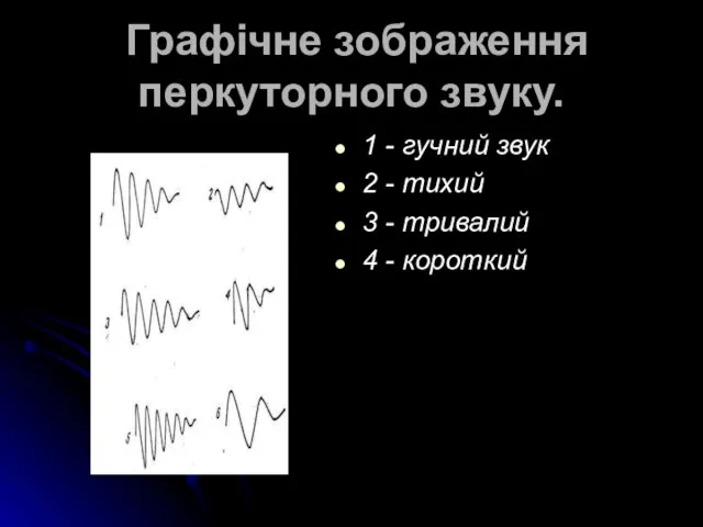 Графічне зображення перкуторного звуку. 1 - гучний звук 2 - тихий