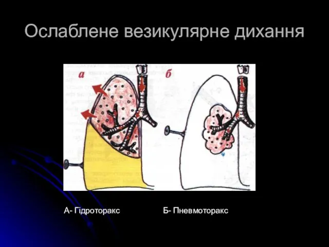 Ослаблене везикулярне дихання А- Гідроторакс Б- Пневмоторакс