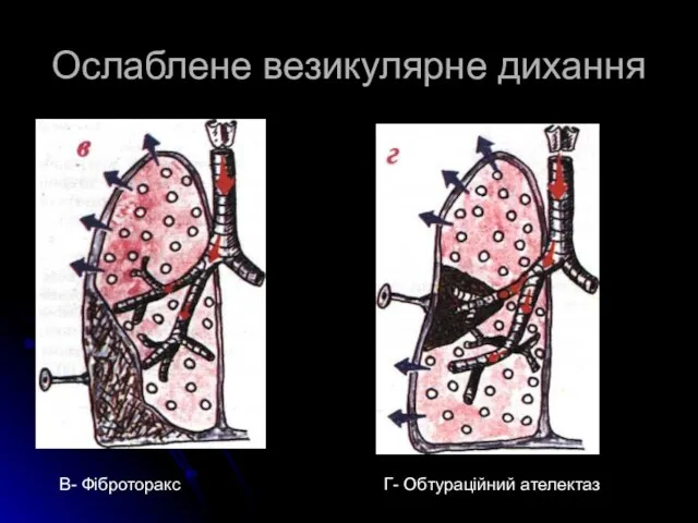 Ослаблене везикулярне дихання В- Фіброторакс Г- Обтураційний ателектаз