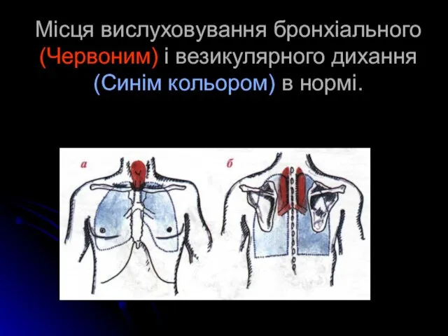 Місця вислуховування бронхіального (Червоним) і везикулярного дихання (Синім кольором) в нормі.