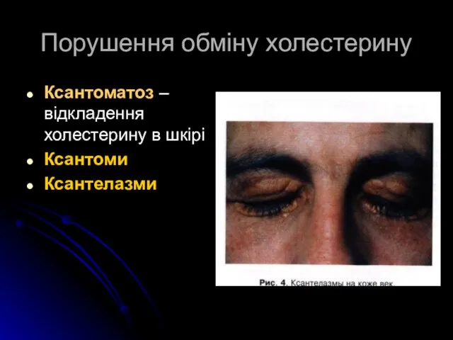 Порушення обміну холестерину Ксантоматоз – відкладення холестерину в шкірі Ксантоми Ксантелазми