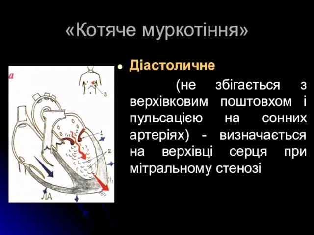 «Котяче муркотіння» Діастоличне (не збігається з верхівковим поштовхом і пульсацією на