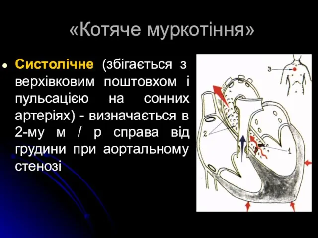 «Котяче муркотіння» Систолічне (збігається з верхівковим поштовхом і пульсацією на сонних