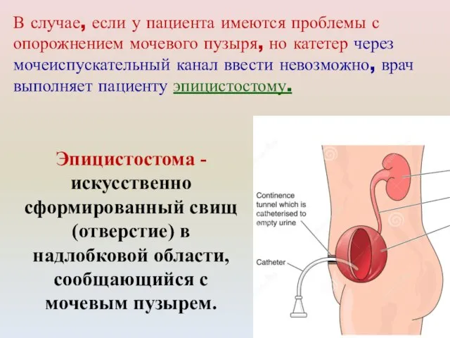 Эпицистостома - искусственно сформированный свищ (отверстие) в надлобковой области, сообщающийся с