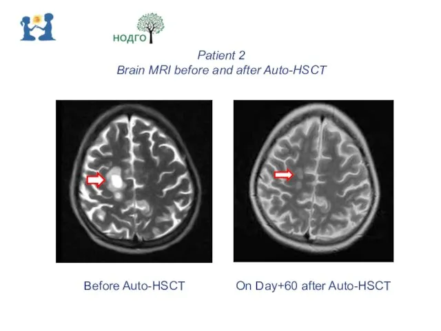 Patient 2 Brain MRI before and after Auto-HSCT Before Auto-HSCT On Day+60 after Auto-HSCT