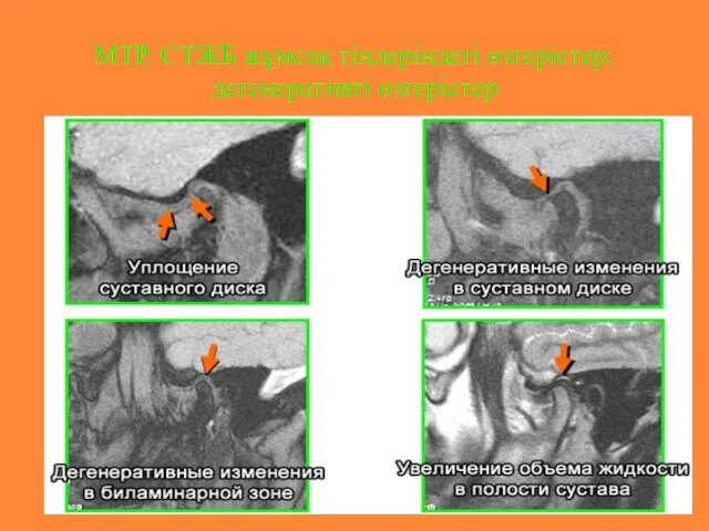 МТР. СТЖБ жұмсақ тіндеріндегі өзгерістер: дегенеративті өзгерістер