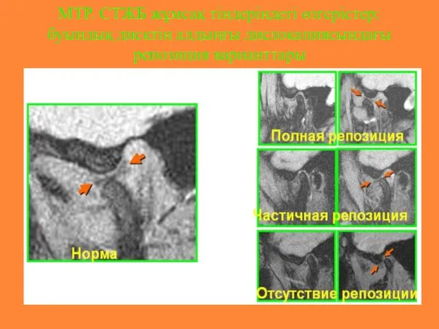 МТР. СТЖБ жұмсақ тіндеріндегі өзгерістер: буындық дисктің алдыңғы дислокациясындағы репозиция варианттары