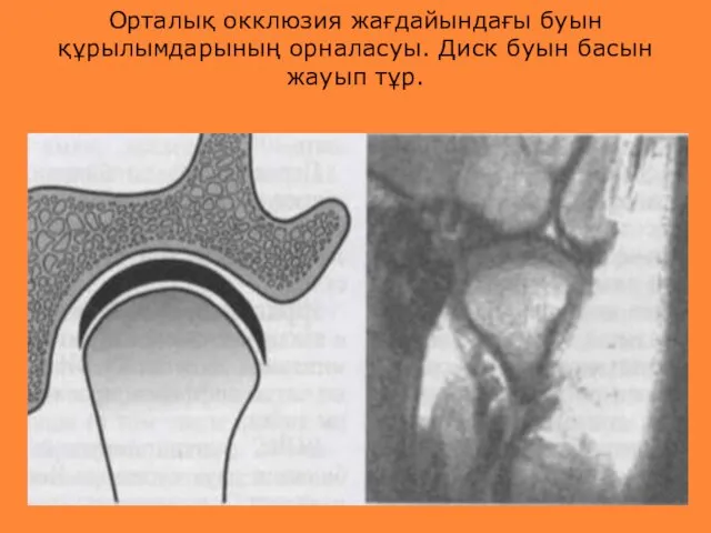 Орталық окклюзия жағдайындағы буын құрылымдарының орналасуы. Диск буын басын жауып тұр.