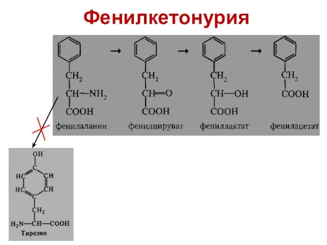 Фенилкетонурия