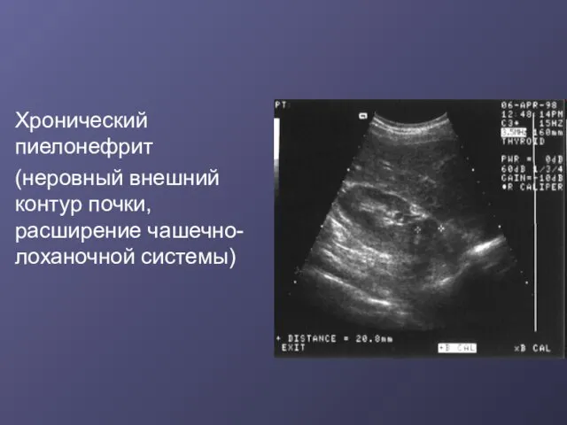 Хронический пиелонефрит (неровный внешний контур почки, расширение чашечно-лоханочной системы)