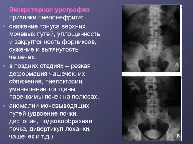 Экскреторная урография признаки пиелонефрита: снижение тонуса верхних мочевых путей, уплощенность и