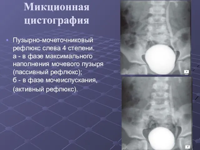 Микционная цистография Пузырно-мочеточниковый рефлюкс слева 4 степени. а - в фазе